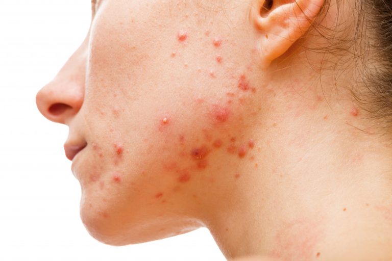 Acne on woman growing